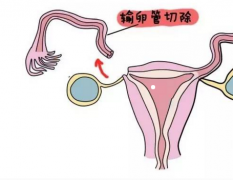 宫外孕切除了输卵管，影响试管成功率吗
