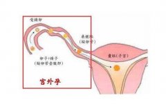 做试管会有宫外孕的情况吗？